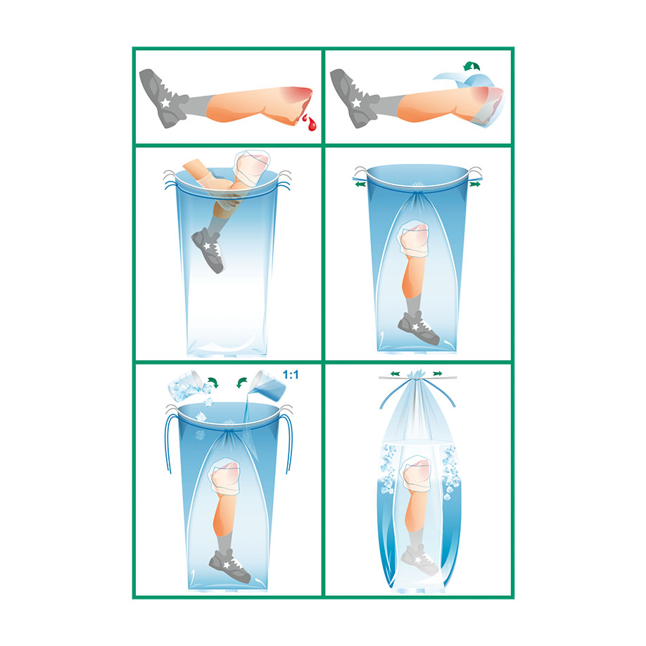 wero-replantat-beutel-steril-bein-doppelwandbeutel-110-x-40-cm-anwendung