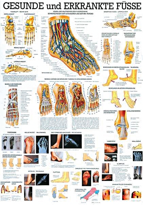 anat. Lehrtafel: Gesunde und erkrankte Füße 70 x 100 cm, laminiert
